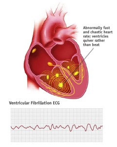 Ventricular Fibrillation