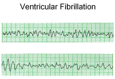 What Is Vf Vt And Asystole Cpr Test