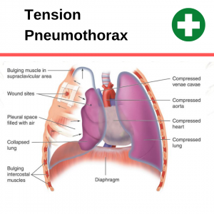 Can CPR Cause a Pneumothorax (collapsed lung)? – CPR Test