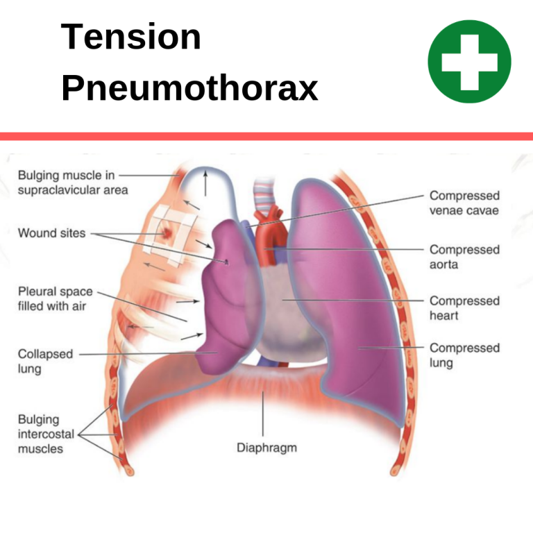 Can CPR Cause a Pneumothorax (collapsed lung)? CPR Test
