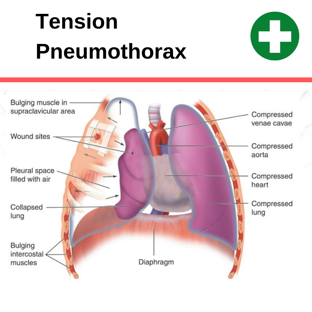 pneumothorax vs atelectasis